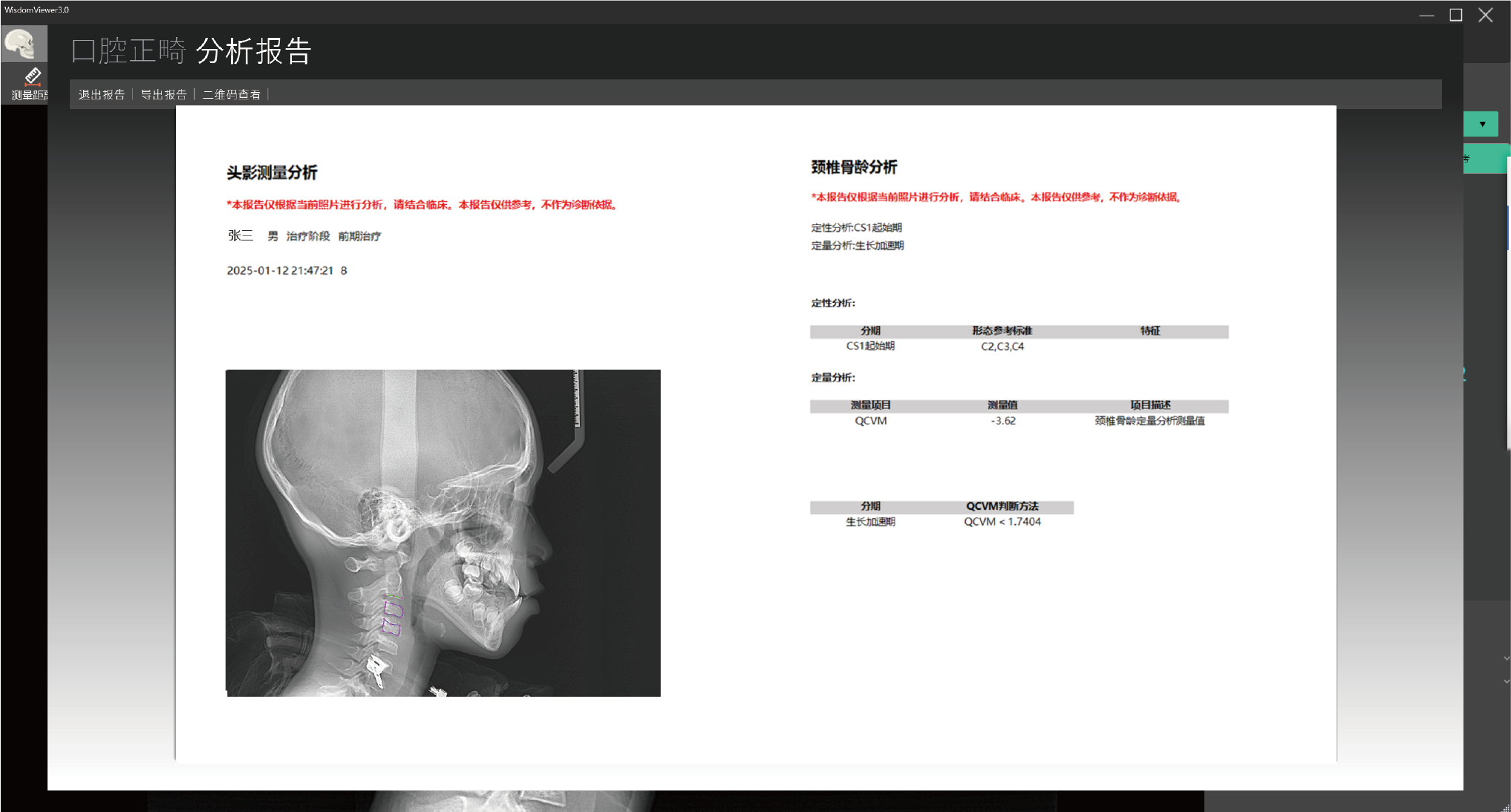 正畸软件骨龄分析报告